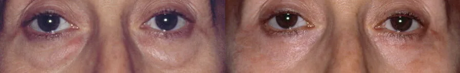 Blefaroplastica inferiore: intervento laser su borse sotto gli occhi