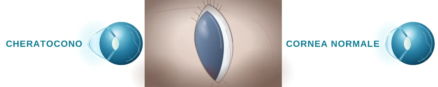 Illustrazione della cornea nel cheratocono
