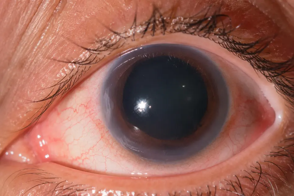 Occhio osservato durante una visita oculistica per il glaucoma
