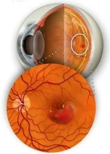 Dettaglio Macula