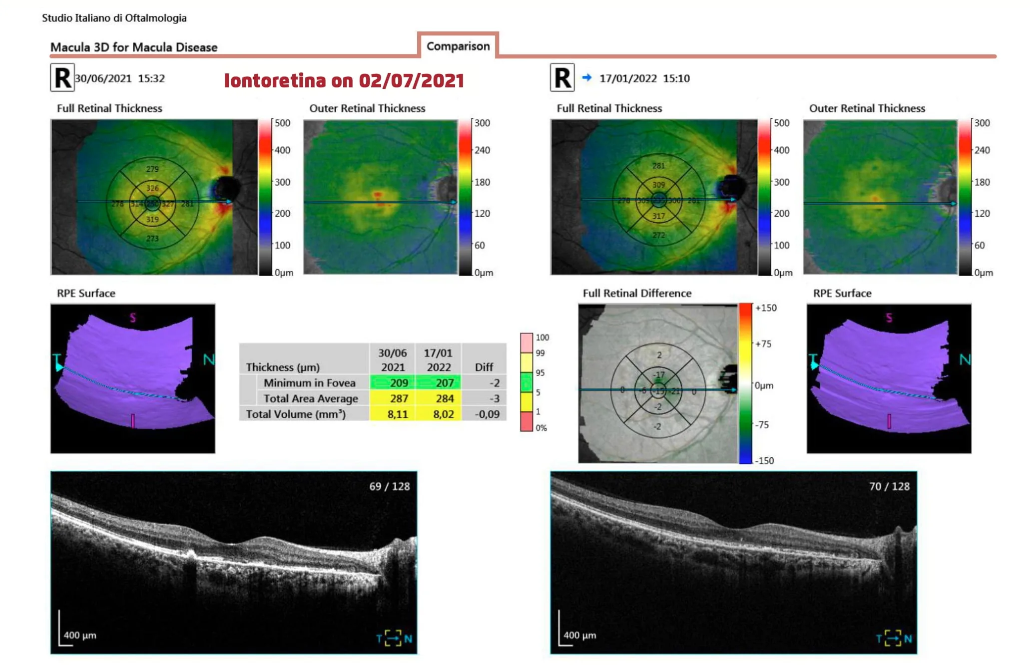Iontoforesi sclerale per la somministrazione topica di luteina