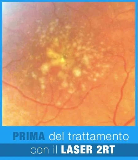 AMD Prima del trattamento